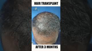 Hair Transplant Journey #tamiralife #hairtransplant