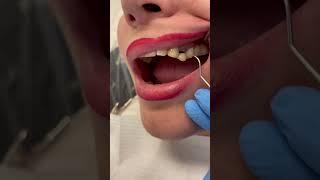 Broken crown #fyp #tiktok #video #viral #trending #dentist #desigamer #love ##smile #love #tooth