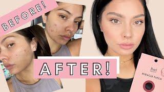 How to get rid of acne fast | How I got clear skin 2021 | How to get rid of a zit