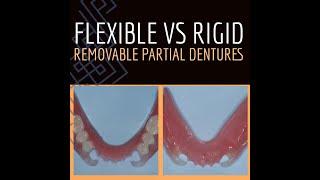 V2538 Flexible vs. Rigid Removable Partial Dentures