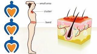 Shingles - The causes, symptoms, treatment and prevention