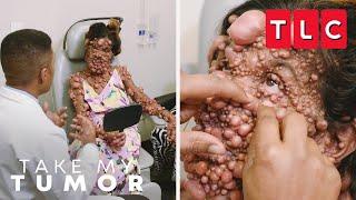 A One-Of-A-Kind Case of Neurofibromatosis | Take My Tumor | TLC