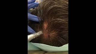 PRP for Hair Loss | PRP Hair Restoration | Beleza MedSpa Austin, TX