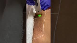 Brazilian Laser Hair Removal Session