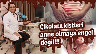 ÇİKOLATA   KİSTİ NEDİR? (Çikolata kisti kısırlık yapar mı? Çikolata kisti belirtileri)