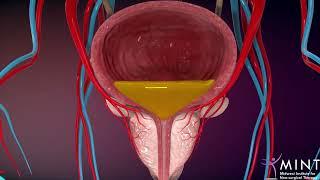 Prostate Artery Embolization (PAE) video