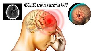 Бас ми абсцессі ауруы. Черепной давления пайда болады. Абсцессті антибиотиксіз емдеу өлімге әкеледі