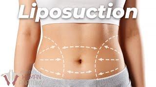 The truth about Liposuction