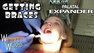 Whitney is getting Braces! | Step 2 Palatal Expander