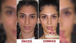 WHO is a GOOD CANDIDATE for RHINOPLASTY | Milano Clinic Turkey