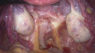 Disc excision in large endometriosis nodules of mid rectum and vagina