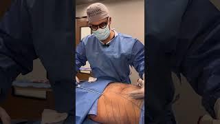 Reno/Tahoe 360 Liposuction Procedure | Dr. Erez Dayan | Avance Plastic Surgery