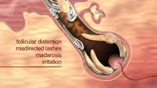 Learn how Demodex mites cause blepharitis