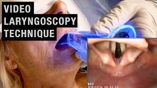 Video Laryngoscopy (GlideScope) Technique