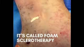 Склеротерапия при хронической недостаточности нижних конечностей. #sclerotherapy