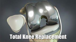 Total Knee Replacement