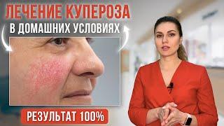 Купероз на лице как избавиться, почему появляется. Лечение купероза в домашних условиях.