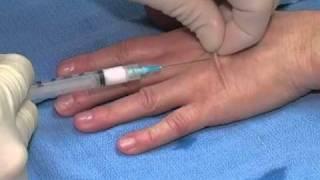 Dr. Bidic Performs Hand Rejuvenation with Sculptra and Radiesse