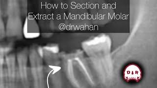 How to Section and Extract a Mandibular Molar @drwahan