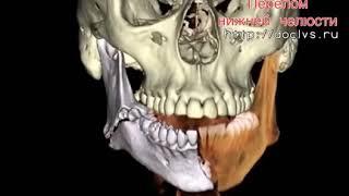 Перелом нижней челюсти