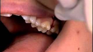 V4103 - Easy Third-Molar Extractions