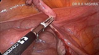 Laparoscopic Bilateral Salpingectomy