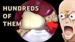 HUNDREDS of TONSIL STONES | AIM 31