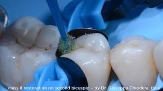 Class II restoration on second bicuspid using myQuickmat Forte kit - Dr. Chiodera