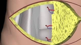 Breast Reconstruction - DIEP procedure Narration and Animation by Cal Shipley, M.D.