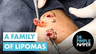 A Family Of Lipomas