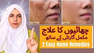 Melasam ,Brown Spots ,Freckles Treatment At Home || Easy Home Remedies ||  Guaranteed || aaqsanoman