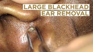 Large blackhead removed from the ear | Dr Cameron McIntosh