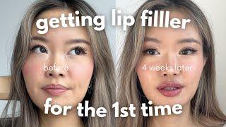 first time getting lip filler??!? | 4 week healing process vlog