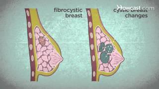 How to Recognize Breast Cancer Symptoms