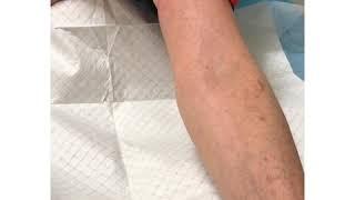 How To Look For Veins On A Older Adult With Small Veins