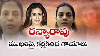 Big Twist In Ranya Rao Gold Smuggling Case | నటి రన్యారావుముఖంపై, కళ్లకింద గాయాలేంటి..?