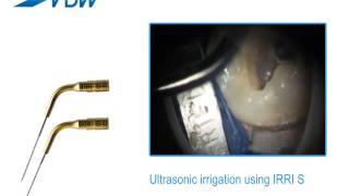 VDW Dental · How To: VDW.ULTRA - Ultrasonic irrigation using IRRI S