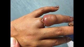 How do you remove a ring from a swollen finger