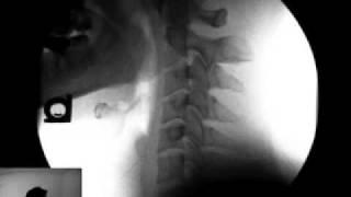 Chiropractor| Vancouver Washington| Car Accident | Whiplash | Portland Oregon