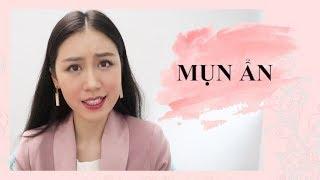 THANH LÝ MỤN ẨN!!! NGUYÊN NHÂN | GIẢI PHÁP | DÙNG SẢN PHẨM GÌ?