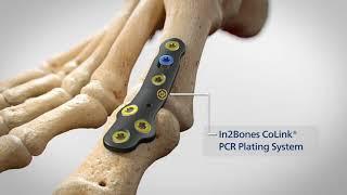 Invibio’s PEEK-OPTIMA™ Ultra Reinforced carbon fiber technology & In2Bones’ CoLink® PCR plate system