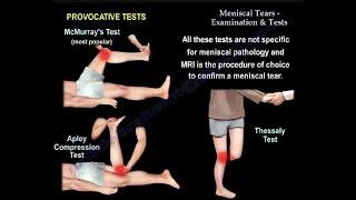 Meniscal Tears Examination & Tests -