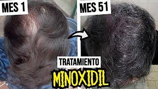 51 Meses Tratando la CALVICIE con MINOXIDIL ¡Resultados Geniales! | Tratamiento Alopecia hombres