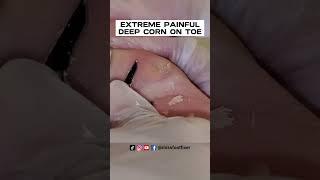 EXTREME PAINFUL DEEP CORN ON TOE 2023 PROPER TREATMENT BY FAMOUS PODIATRIST MISS FOOT FIXER