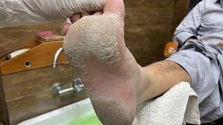 Huge foot | Geating the Massive pedicure  | Removed yellow hard skin | Removal calluses