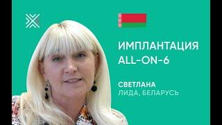 Имплантация зубов в Минске за 5 дней. Отзыв через 4 месяца. ДО/ПОСЛЕ. Все-на-6 (All on 6)