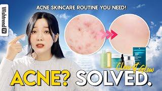 Best Acne Skincare Routine  | Products That Actually Work