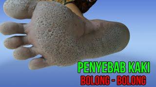 Penyebab Kaki Bolong bolong