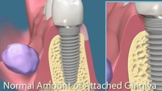 Consult-Pro Dental Patient Education Videos