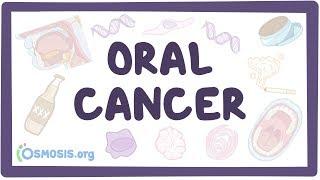 Oral Cancer - causes, symptoms, diagnosis, treatment, pathology